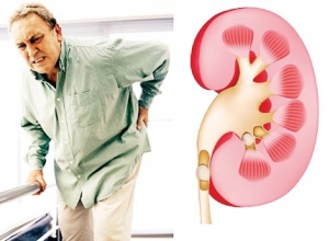 Sỏi thận phải kiêng những gì? Những loại thực phẩm kiêng tuyệt đối với người sỏi thận